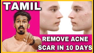 REMOVE ACNE SCAR IN 10 DAYS  TAMIL  HOUSE OF MAVERICK [upl. by Ellahcim]