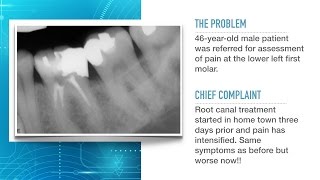 Advances in Endodontic Treatment Part 1Diagnosis and Treatment Planning [upl. by Benedicto]