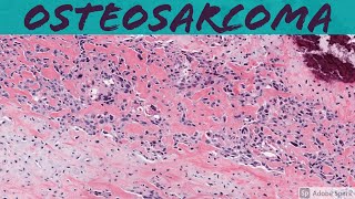 Osteosarcoma 101 Bone Pathology Basics [upl. by Kavanagh159]