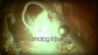 Intravitreal Kenalog Injection [upl. by Zoubek937]