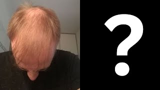 Norwood 5 FUE Hair Transplant by Dr Arshad [upl. by Innes569]