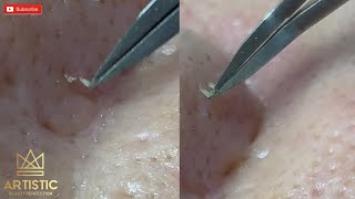 blackheads filaments on nose remove with tweezers กดสิว [upl. by Wunder739]