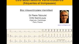 4h Aberration ventriculaire bloc de branche ou ESV  ECG Dr Taboulet [upl. by Atima]