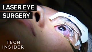 How does laser eye surgery work  Dan Reinstein [upl. by Laenej]