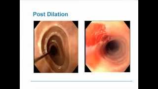 Eosinophilic Esophagitis [upl. by Nosyt]