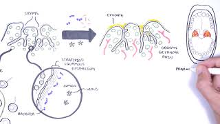 Adenomyosis Symptoms Why Adenomyosis Is Often Misdiagnosed And What to Do About It [upl. by Ecydnac]