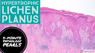 Hypertrophic Lichen Planus 5Minute Pathology Pearls [upl. by Cummings283]