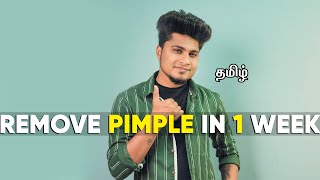 HOW TO REMOVE PIMPLE PERMANENTLY  IN TAMIL  SARAN LIFESTYLE [upl. by Philipa]