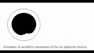 Vermiform movement of the iris spincter muscle  Adies Pupil [upl. by Camile]