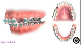 Upper First Premolar Extraction  Dental Braces  Temecula Valley CA [upl. by Aicarg]