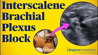 Interscalene Brachial Plexus Block [upl. by Sherry]