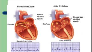 CARDIOLOGIE L’électrocardiogramme [upl. by Karas99]