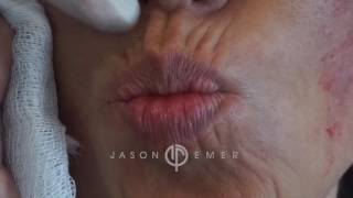 GET BOTOX FOR FINE MOVEMENT LINES amp WRINKLES AROUND THE MOUTH PERIORAL REJUVENATION Dr JASON EMER [upl. by Edwards]