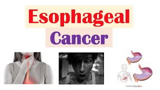 Esophageal Cancer  Risk Factors Pathogenesis Signs and Symptoms Diagnosis Treatment [upl. by Aihsas]