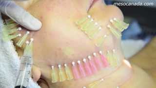 Thread Lifting 4D Mesotherapy [upl. by Ardeed]