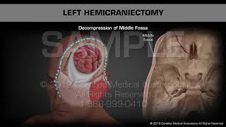 Left Hemicraniectomy  Medical Animation [upl. by Alyahc]