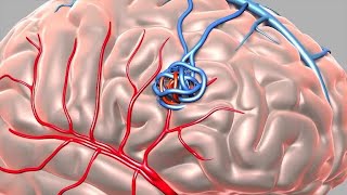 Pipeline Embolization Device [upl. by Tacye]