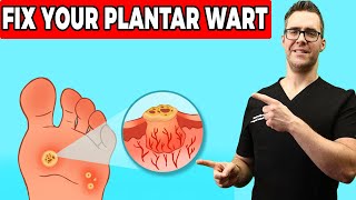 Plantar Warts Removal at Home Treatment Foot amp Toe Wart Remedies [upl. by Evania]