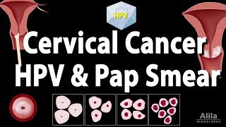 Staging cancers TNM and IIV systems [upl. by Azeria]