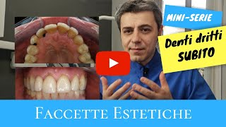 Denti dritti subito faccette estetiche [upl. by Aicul131]