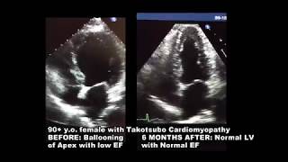 2d Echocardiogram takotsubo Cardiomyopathy [upl. by Gibbs]