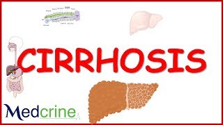 LIVER CIRRHOSIS causespathophysiologyfeaturesdiagnosistreatment [upl. by Einegue971]