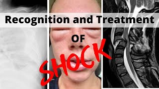 Recognition and Treatment of Shock [upl. by Mabelle]