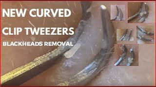 New curved clip tweezers blackheads removal [upl. by Fletcher]