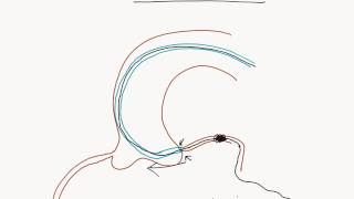 Coronary Angioplasty Femoral Access [upl. by Frohne]