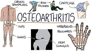 Esofagitis Erosiva [upl. by Swarts]