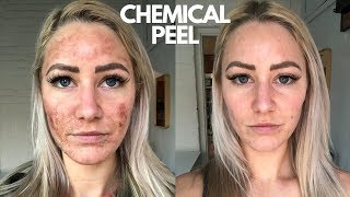 Chemical Peel On Sensitive Skin NEVER AGAIN [upl. by Nealah828]