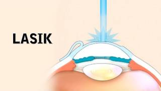 How LASIK Eye Surgery Is Performed [upl. by Noemis]