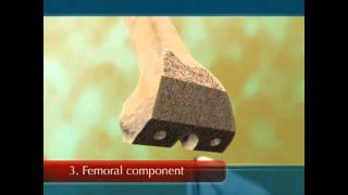 Stryker Knee Replacement Video [upl. by O'Connell]