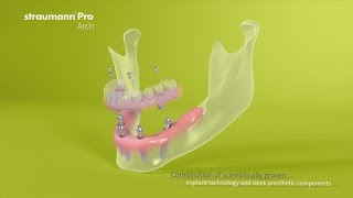 Straumann® Pro Arch US Version [upl. by Kipp]