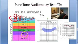 ENT 041 a Pure Tone Audiometry PTA test [upl. by Goldarina]