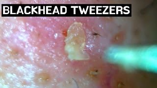 8 Pull out Blackheads  Whiteheads Close up with tweezers 300X  Blackheads Removal [upl. by Balas368]