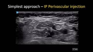 UltrasoundGuided Continuous Interscalene Brachial Plexus Block  Regional Anesthesia [upl. by Winou]