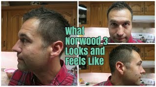 What Norwood 3 Looks and Feels Like Receding HairlineBalding [upl. by Darton]