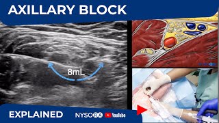 What to expect during a Nerve Root Block at RAYUS [upl. by Trask]