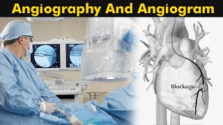 Angiogram Procedure Risks and Benefits [upl. by Hibbitts]