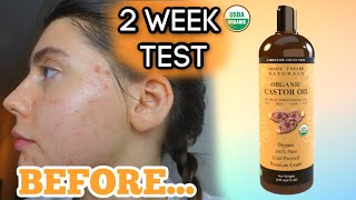 I TESTED PURE CASTOR OIL ON MY FACE FOR MY ACNE SCARS FOR 2 WEEKS  My review and thoughts [upl. by Irv436]