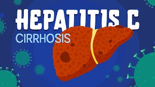 New Hepatitis C Treatment and Cure 2015 [upl. by Zosima518]