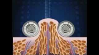 How Endermologie® works lipomassage [upl. by Nyleikcaj]