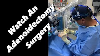 Adenoidectomy  actual footage [upl. by Eelhsa557]