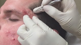 Super Satisfying Blackhead Removal [upl. by Nagn]