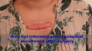 Chest Keloids  Mistakes to Avoid [upl. by Annavoeg]