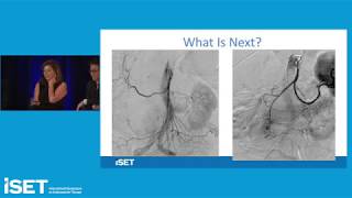 Angiogram  BRAIN angio procedure video [upl. by Paulina603]