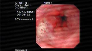 GI Disorders GERD Gastritis peptic ulcer Disease Part 5 [upl. by Wiles]