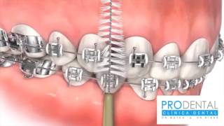 ¿Cómo lavarse correctamente los dientes con brackets [upl. by Chafee108]