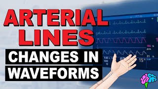 Common Changes in Arterial Line Waveforms [upl. by Ahsekal973]